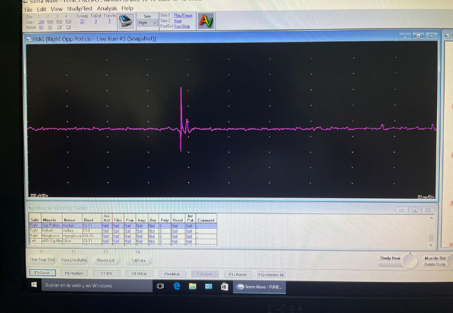 Velocidades de Conducción y Electromiografia